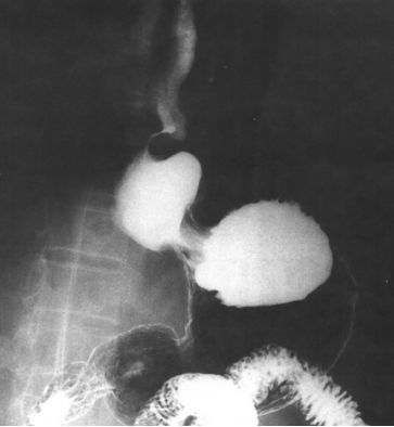 食管疾病的X线造影 食管疾病的X线造影