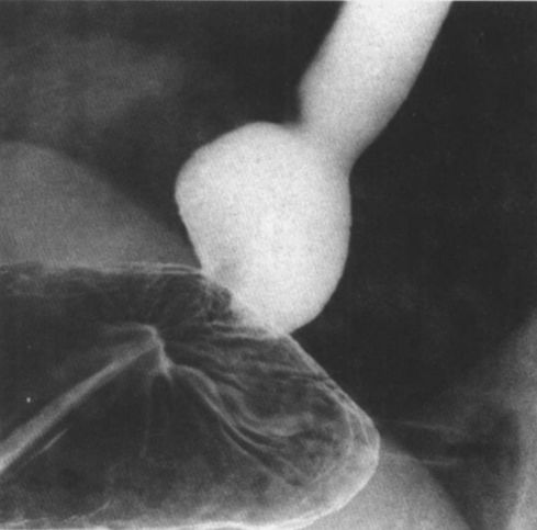 食管疾病的X线造影 食管疾病的X线造影