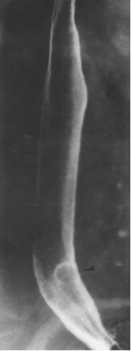 食管疾病的X线造影 食管疾病的X线造影