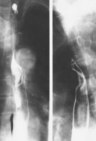 食管疾病的X线造影 食管疾病的X线造影