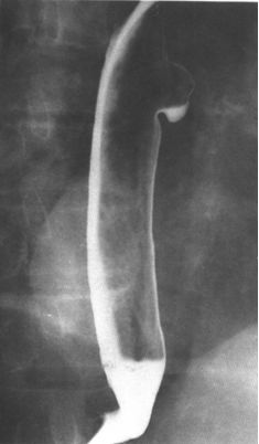 食管疾病的X线造影 食管疾病的X线造影