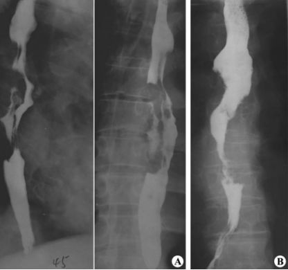 食管疾病的X线造影 食管疾病的X线造影