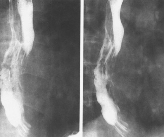食管疾病的X线造影 食管疾病的X线造影