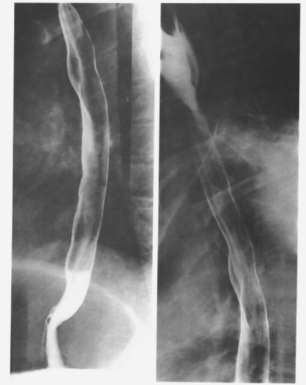 食管疾病的X线造影 食管疾病的X线造影