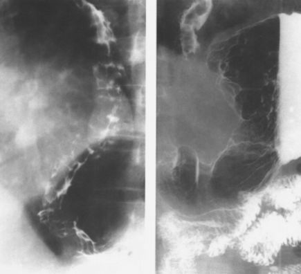 食管疾病的X线造影 食管疾病的X线造影