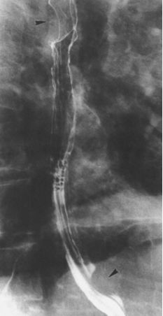 食管疾病的X线造影 食管疾病的X线造影