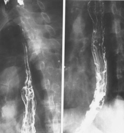 食管疾病的X线造影 食管疾病的X线造影