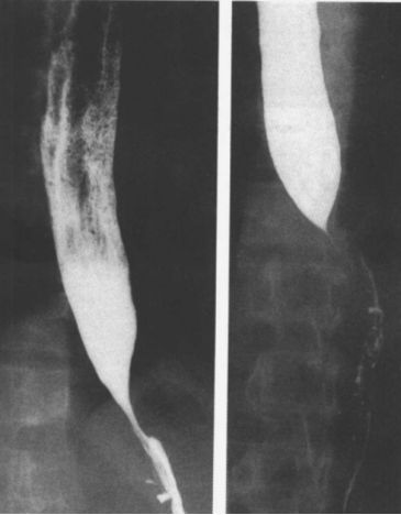 食管疾病的X线造影 食管疾病的X线造影