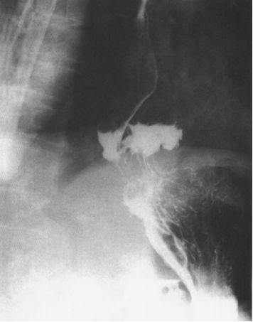 食管疾病的X线造影 食管疾病的X线造影