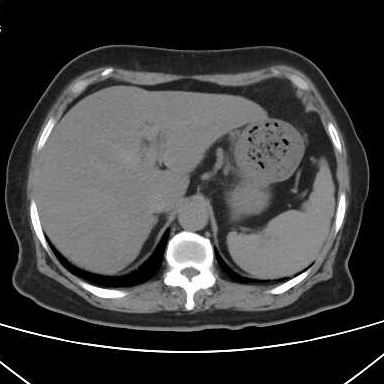 胃结石的2个病例-老苏