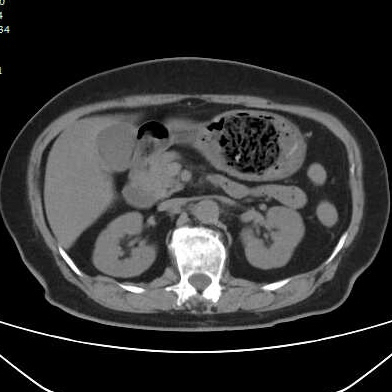 图片[2]-胃结石的2个病例-老苏