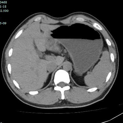 图片[3]-胃结石的2个病例-老苏