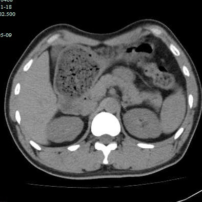 图片[4]-胃结石的2个病例-老苏