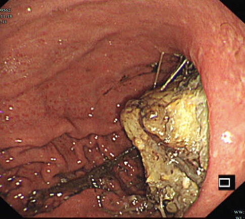 图片[5]-胃结石的2个病例-老苏