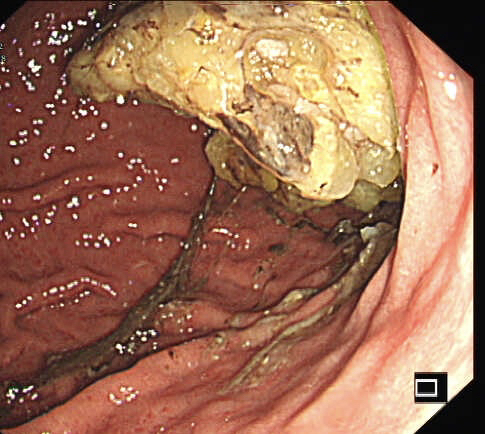 图片[6]-胃结石的2个病例-老苏