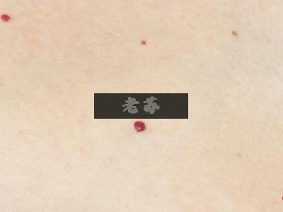 身上长这种小红点，真的一定是肝出问题了吗？